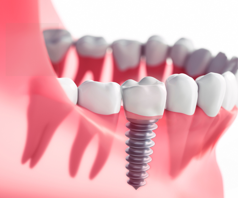 blog art dentica duże zdj (25)