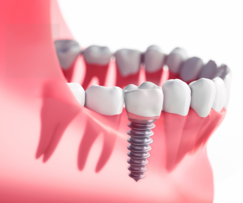 blog art dentica duże zdj (34)