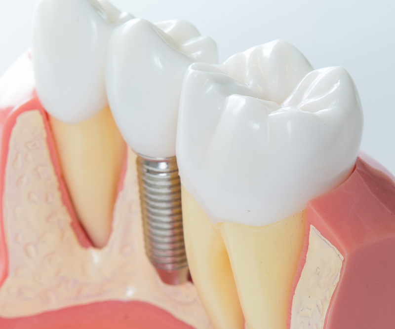 blog art dentica duże zdj (63)